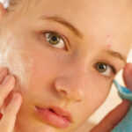 acne breakout pimples redness