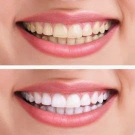 Whitening teeth