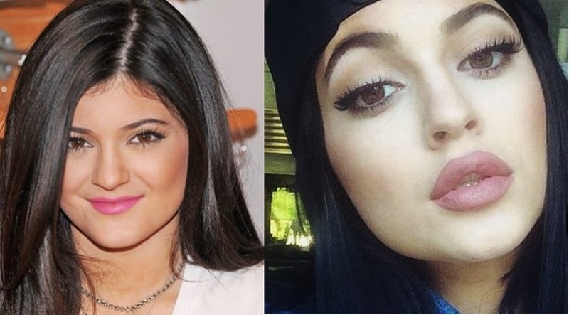 Kylie Jenner before and after lip plumping injection