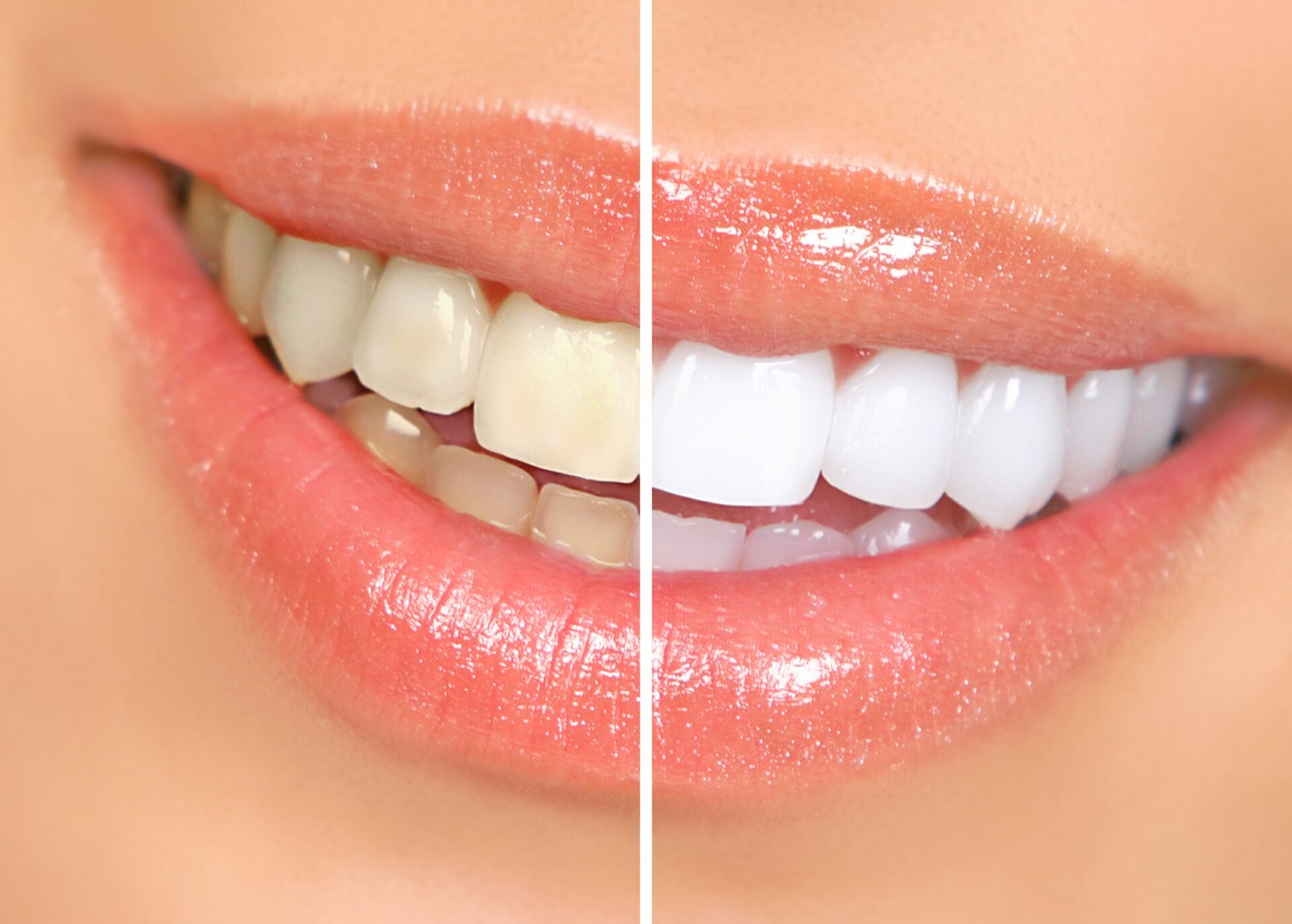 Whiten Your Teeth Easily At Home | Brighten your smile